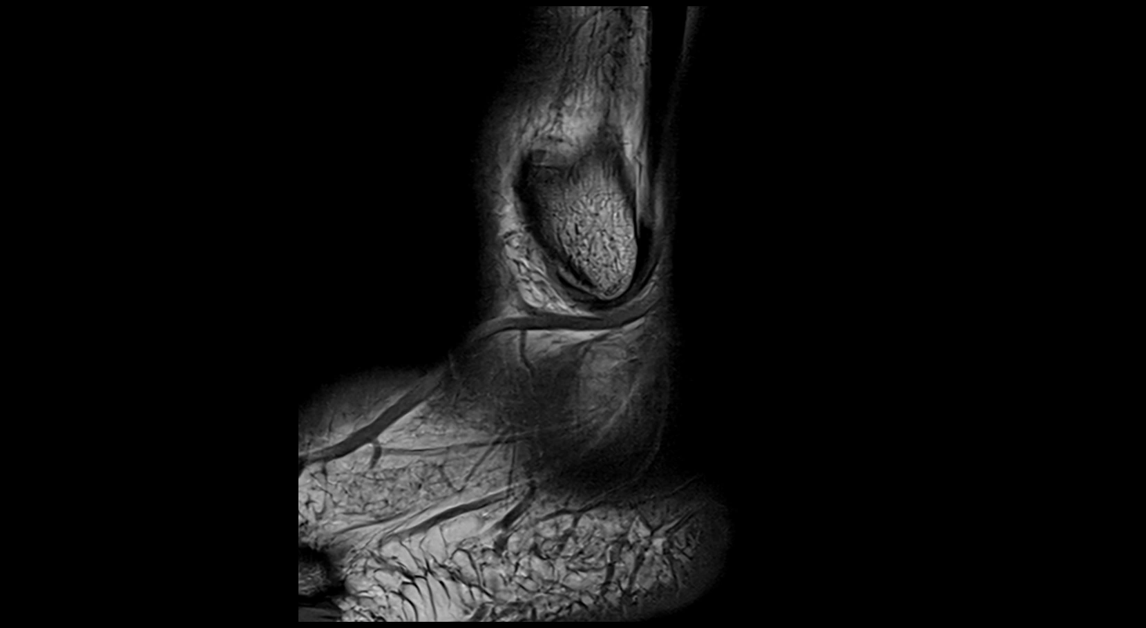 MRI ankle ligaments anatomy sagittal 3T image 27.webp